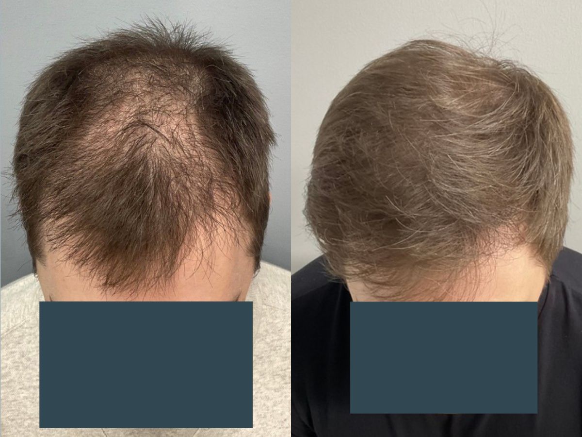 Before and after FUE hair transplant at Pasadena Hair Transplant – 3000 grafts, 9 months post-op