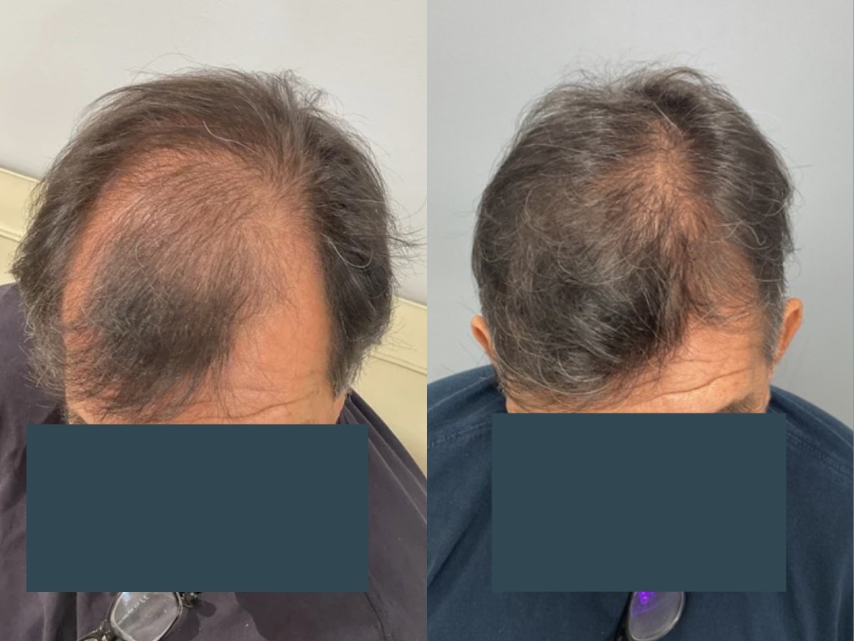 Before and after FUE hair transplant at Pasadena Hair Transplant – 3000 grafts, 7 months post-op