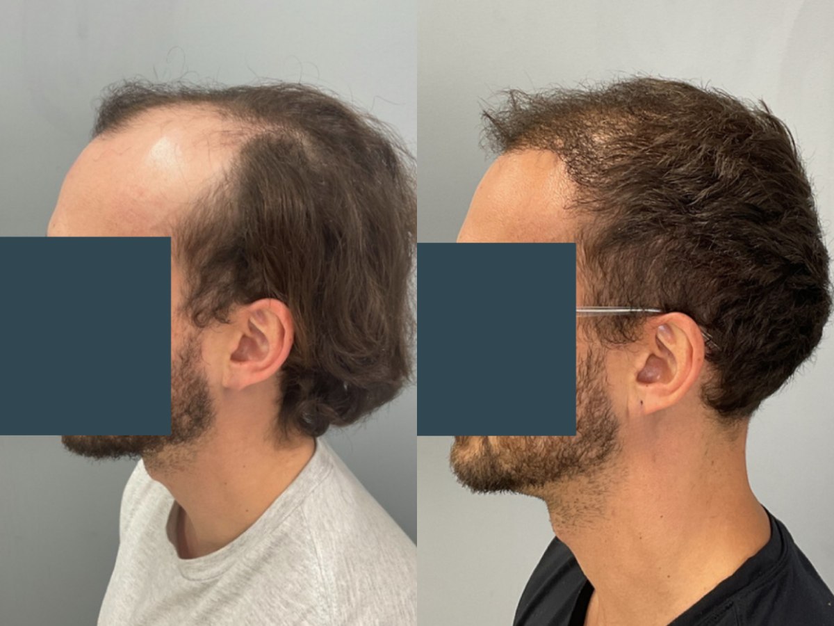 Before and after FUE hair transplant at Pasadena Hair Transplant – 4000 grafts, 7 months post-op