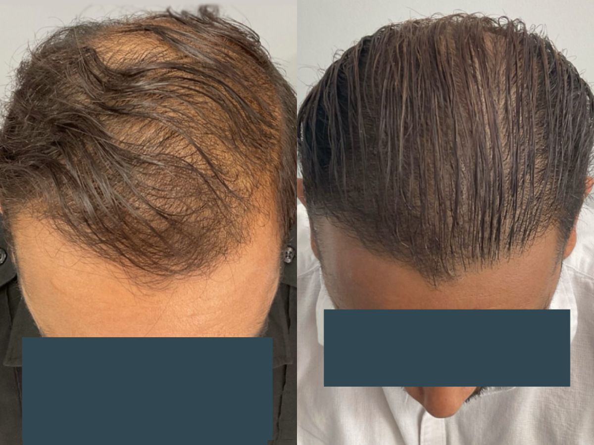 Before and after FUE hair transplant at Pasadena Hair Transplant – 3000 grafts, 1 year Post-Op