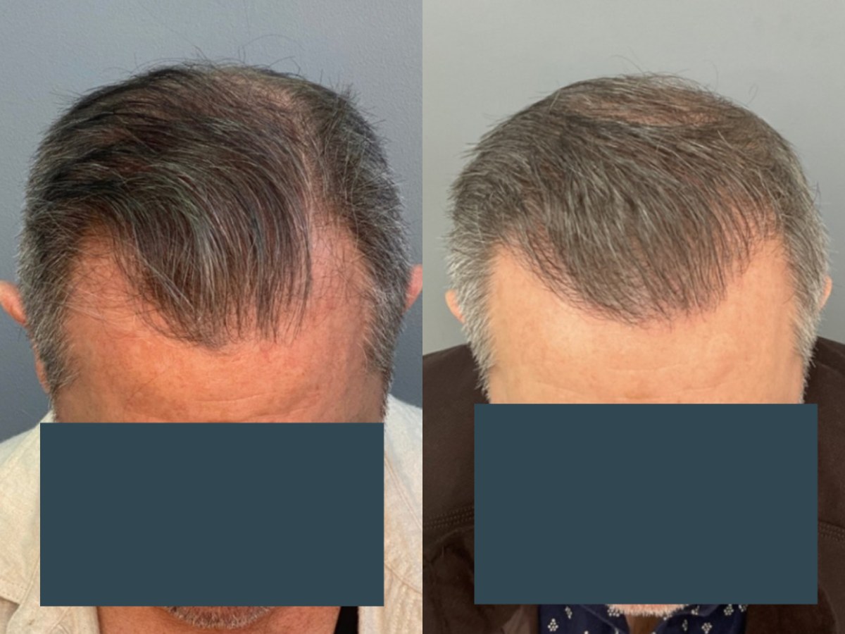 Before and after FUE hair transplant at Pasadena Hair Transplant – 2500 grafts, 1.5 years post-op